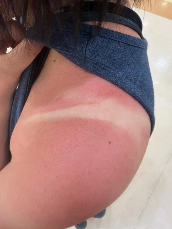 痛いよ😣